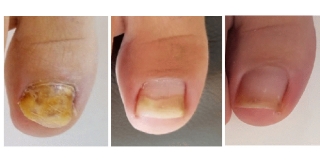Riješite se gljivica na noktima laserskim tretmanima