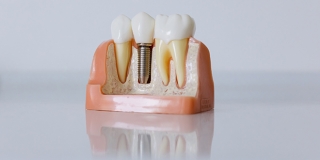 Nadomjestite izgubljen zub po akcijskoj cijeni u Dentechu