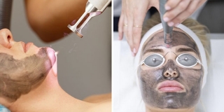 Carbon laser peel za ljepšu kožu u Skin Clinic centru