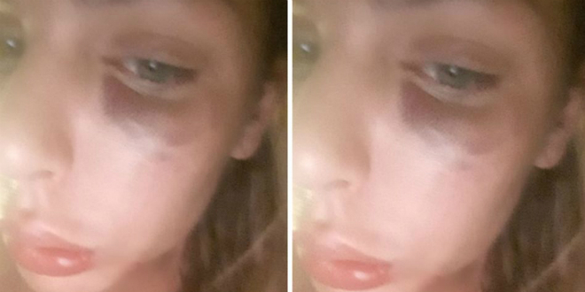 Ava Karabatić šokirala pratitelje na Instagramu: 'Moje krvavo Valentinovo'
