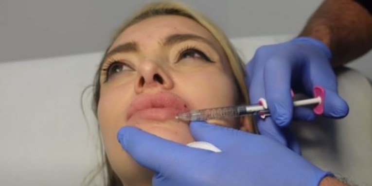 VIDEO Ella Dvornik objavila snimke estetskih zahvata kojima se podvrgnula