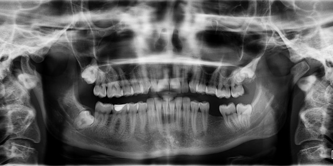 Zubar otkriva 5 stvari koje vam zubi govore o vašem zdravlju