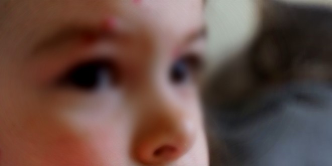 OPASNOST IZ SUSJEDSTVA Male boginje u Srbiji, oboljelo šest necijepljenih osoba