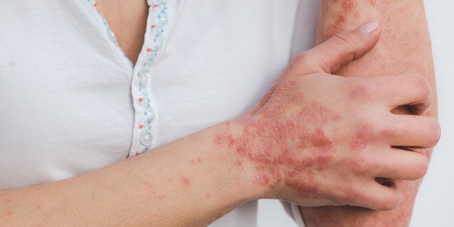Okidači za izbijanje psorijaze